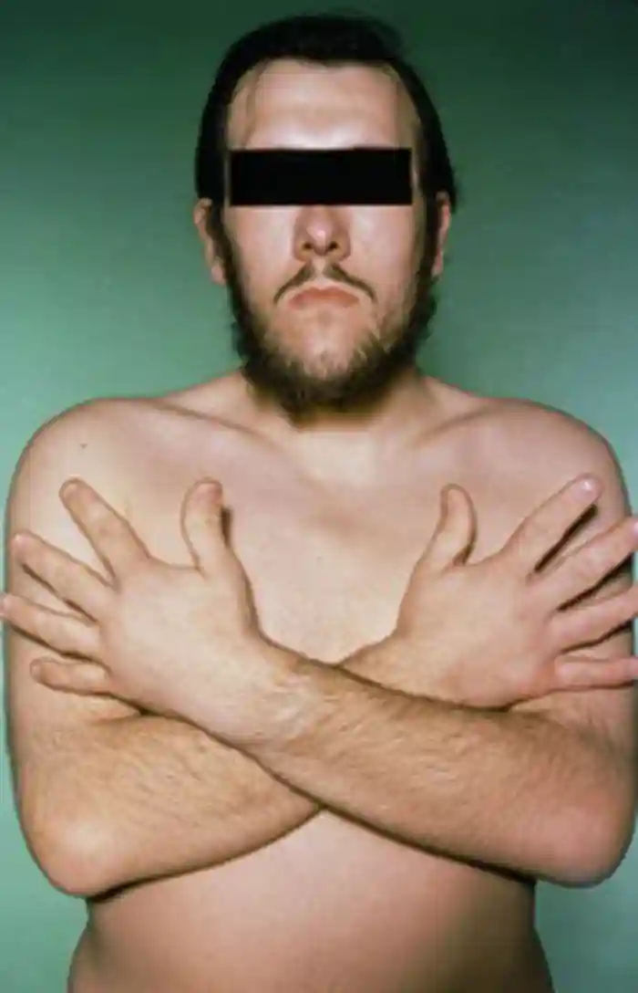 Image showing a gentleman with some features of acromegaly – prominent ridges above the eyes and large spade-like hands.