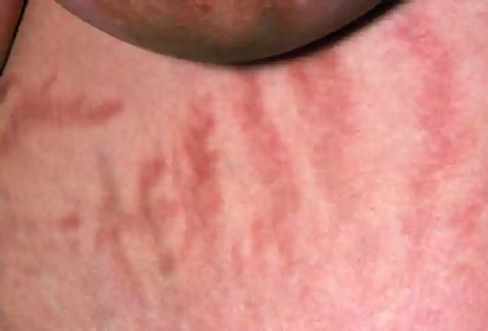 Photo of stretch marks on a woman suffering from Cushing&amp;#x27;s syndrome.