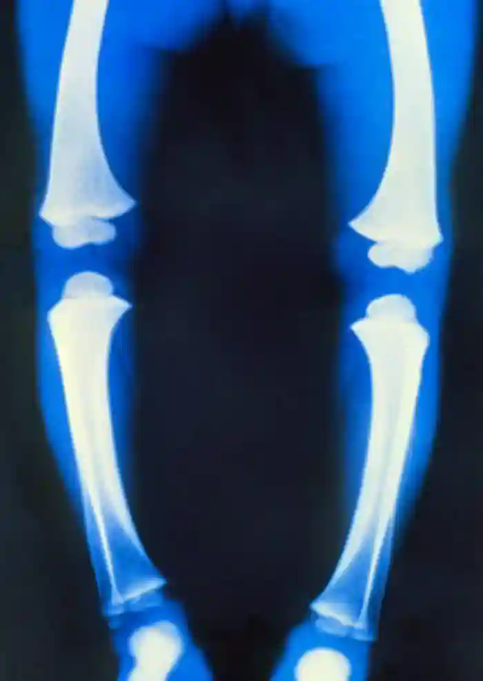 Coloured X-ray of the weakened bones and bowed legs of a child suffering from rickets.