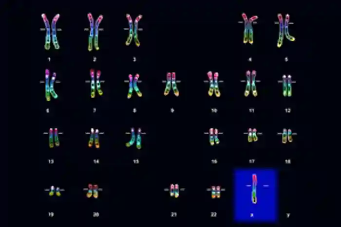 Light micrograph of the chromosomes (karyotype) of a female with Turner syndrome. Turner syndrome is caused by the presence of only one X chromosome (at bottom right, blue highlight).