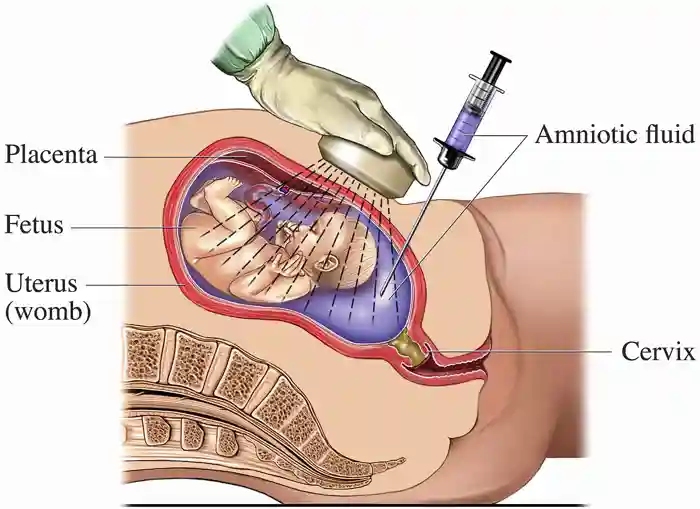 A medical drawing to show the process of amniocentesis, which can be carried out during pregnancy. A fine needed is used to take a sample of amniotic fluid from the mother&amp;#x27;s uterus (womb), which is then analysed to determine the karyotype (chromosome arrangement) of the fetus.