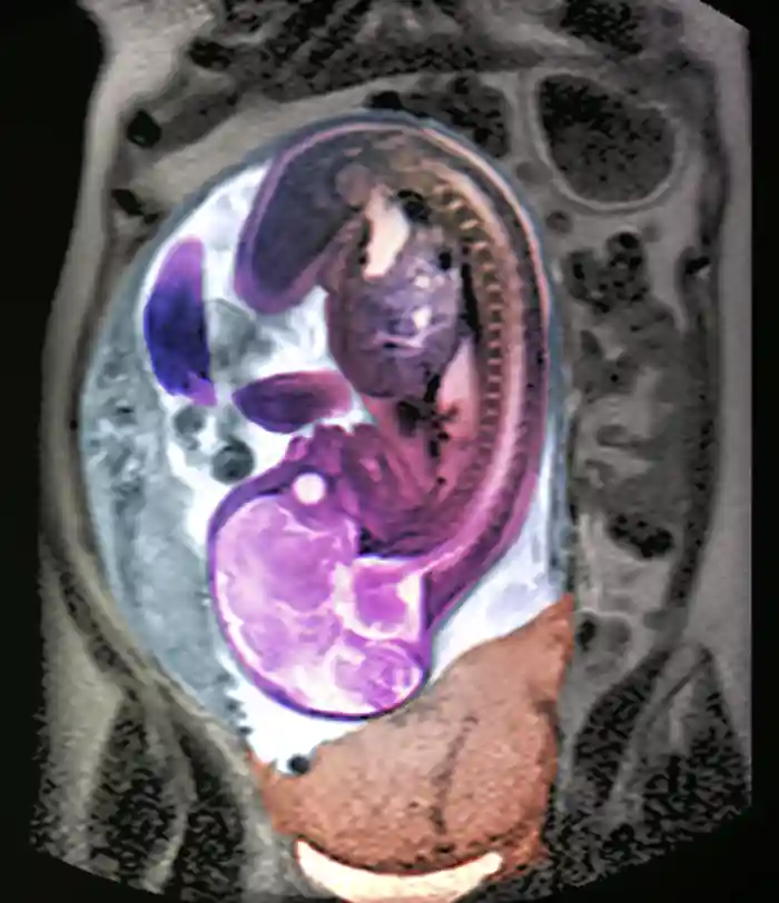 Coloured pelvic magnetic resonance imaging (<a  tabindex='0' class='popover-dismiss' href='/glossary/m#magnetic-resonance-imaging' data-target-type='glossary' data-target-url='/glossary/m#magnetic-resonance-imaging' data-bs-toggle='popover' data-bs-trigger='focus' title='MRI' data-bs-content='1542' >MRI</a>) scan of a pregnant woman with placenta praevia. The placenta (lower centre) is blocking the cervix, the exit to the womb. The fetus is in &amp;#x27;head down&amp;#x27; position (the brain can be seen, lower left).